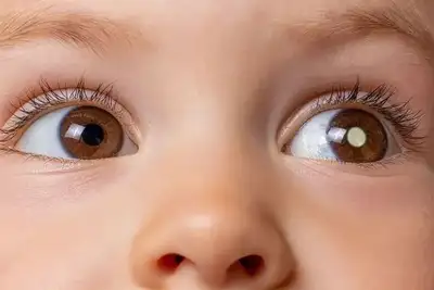 notícia: Amapá adere pela primeira vez à campanha nacional 'De Olho nos Olhinhos' para conscientização sobre câncer ocular