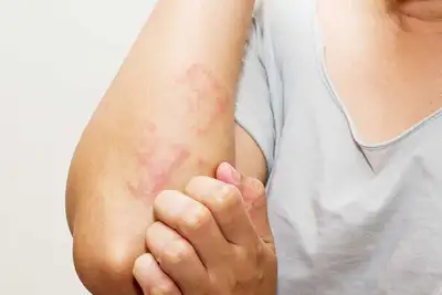notícia: Governo do Amapá orienta sobre dermatite atópica e mostra onde buscar tratamento pelo SUS